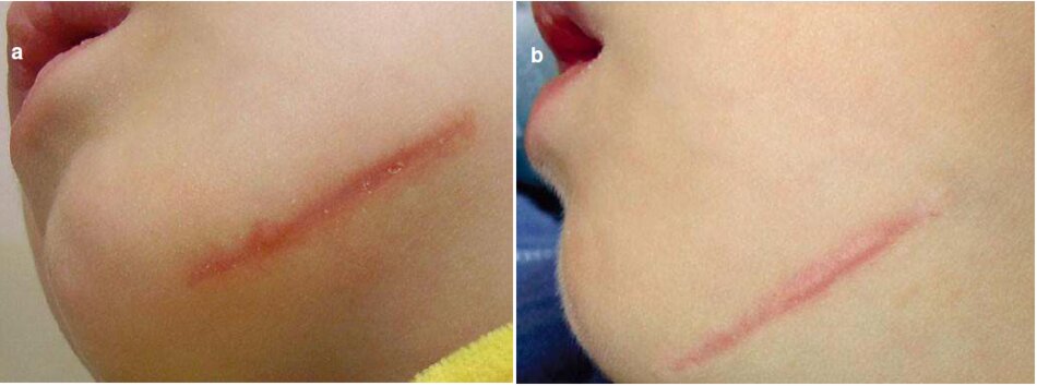 Fig. 3.13 Sẹo môi của vùng cam. Hình thành giai đoạn và điều trị. (a) Trước khi điều trị. (b) Ba tháng sau khi ứng dụng axit ascorbic 5%. (c) Sau khi điều trị