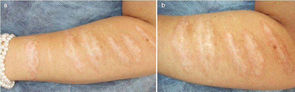 Fig. 3.24 Sẹo của cái tay trái sau khi điều trị bằng laser CO2. (a) Anil toàn cành, (b) Ảnh phóng to 
