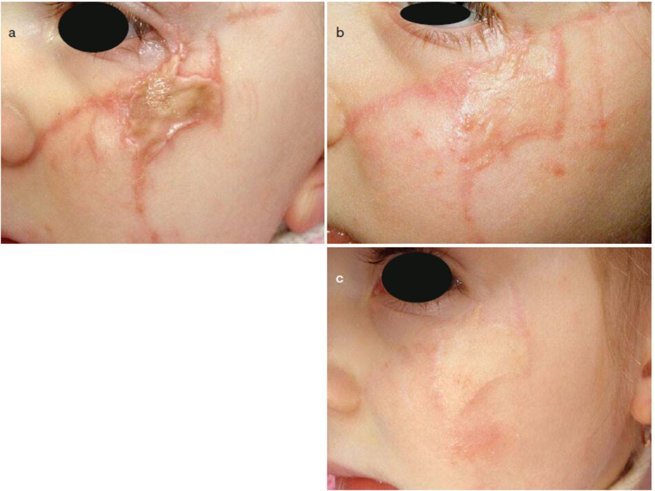 Fig. 4.13 Gò má khu vực vết sẹo hỗn hợp sau khi cắn chó và ghép da. (a) Trước khi điều trị. (b) Trong quá trình này. Bốn tháng sau. (c) Sau khi điều trị