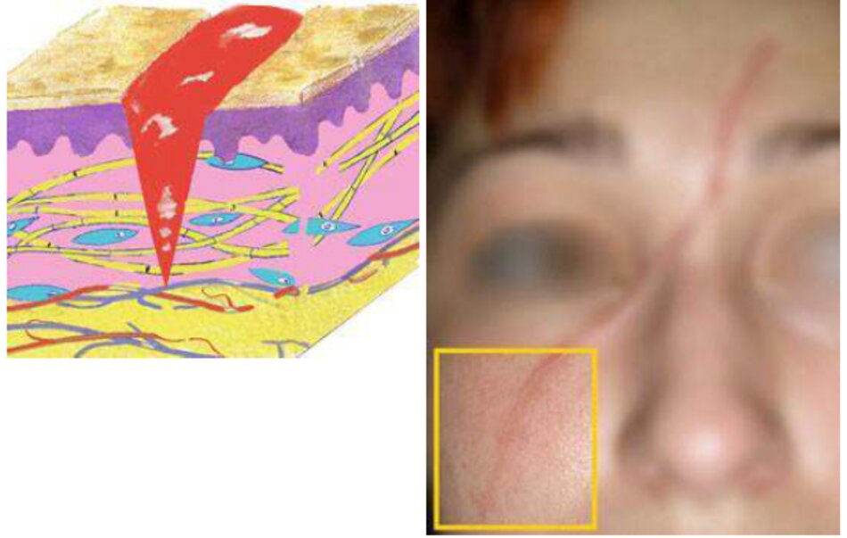 Fig. 4.4 Phân đoạn sẹo thường của vết sẹo hỗn hợp 