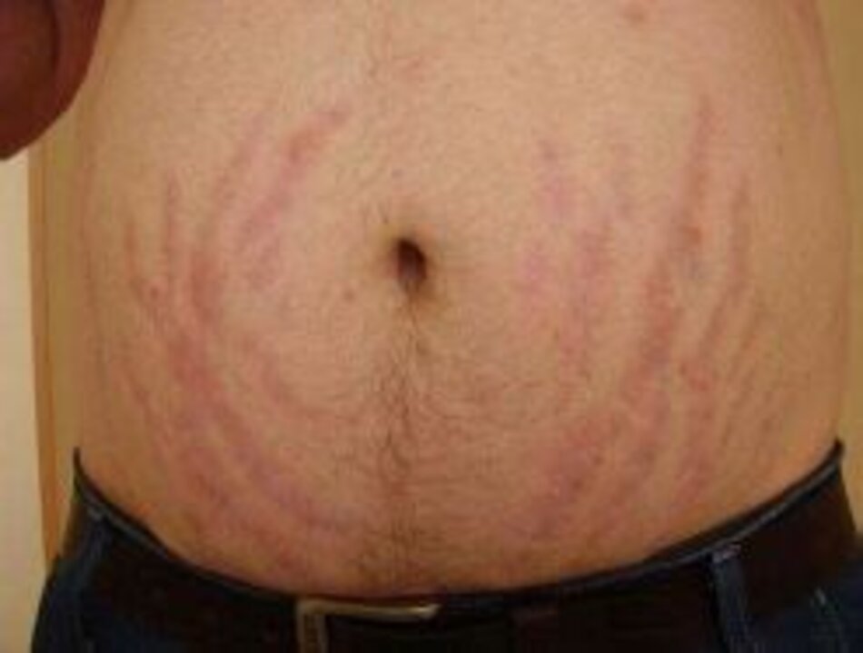 Fig. 1.11 Sẹo do (vết rạn da) của da bụng sau khi điều trị bệnh vẩy nến lâu dài với thuốc mỡ corticosteroid 