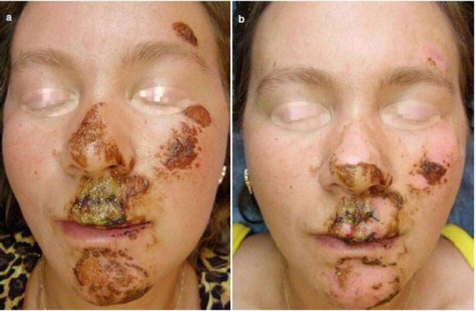 Fig. 1.16 vết thương sau chấn thương và vết trầy xước trên khuôn mặt.. Enzymotherapy Khóa điều trị 2 tháng, (a) tnrởc điều trị. (b) ngày hôm sau. c) sau 2 tháng