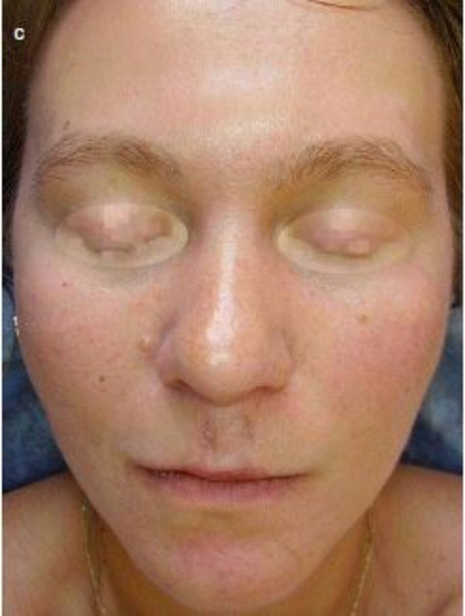 Fig. 1.16 vết thương sau chấn thương và vết trầy xước trên khuôn mặt.. Enzymotherapy Khóa điều trị 2 tháng, (a) tnrởc điều trị. (b) ngày hôm sau. c) sau 2 tháng