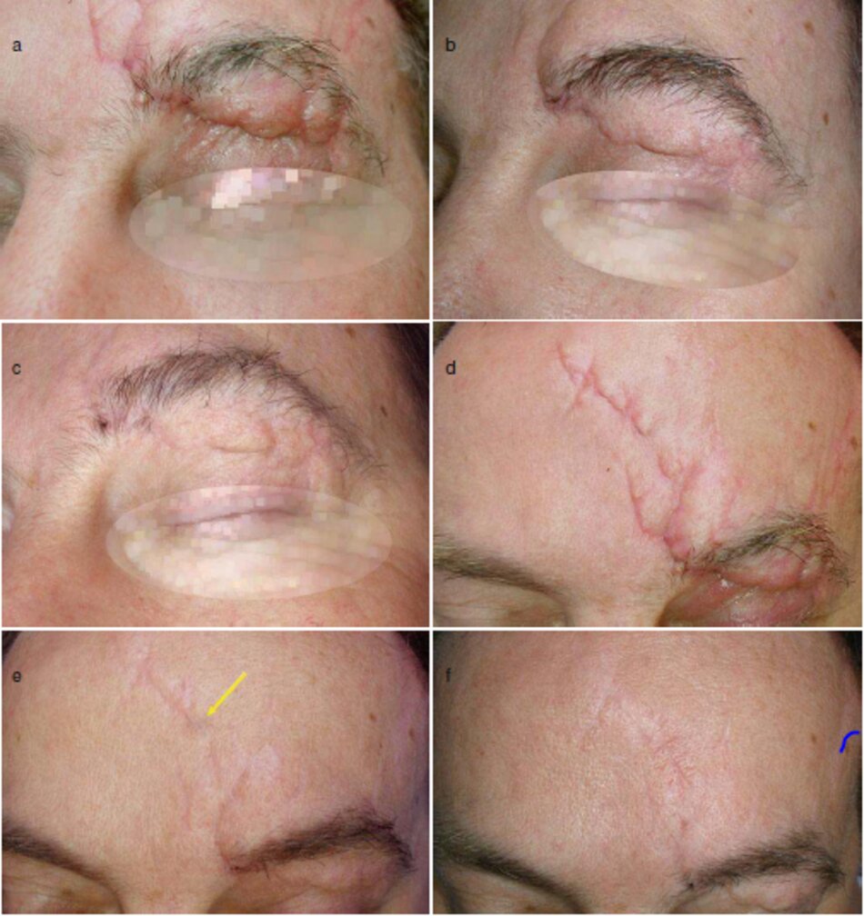 Fig. 1.37 Chấn thương vết sẹo tai nạn ô tô của trán và mí mắt trên, (ta) vết sẹo trên mí mắt trên, (b) Điều tộ (sau 2 tháng), (có) Liệu pháp sau (sau số tháng), (do) Những vết sẹo trước điều tạ trán, (e) Điều trị (sau 2 tháng). (f) Liệu lập sau (sau 6 tháng) 