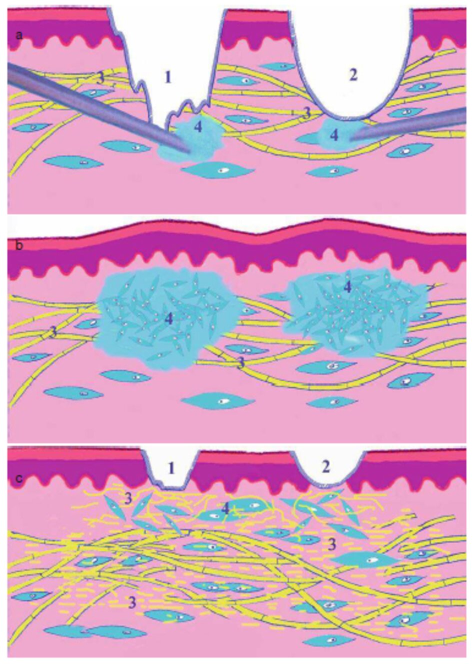 Fig. 1.70 Vết sẹo do mụn của vùng thái dương phía, (a) Trước kill điêu tị. (b) Năm tháng sau kill cày ghép nguyên bào sợi 