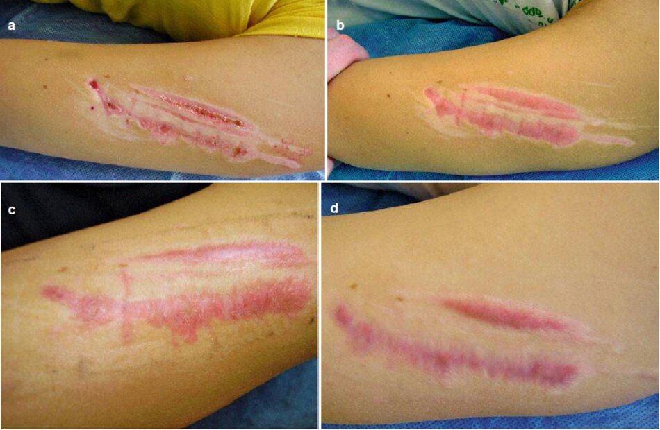 Fig. 2.16 Hình thành sẹo phì đại trên cánh tay trái, (a) Một tháng sau chấn thương, (b) Hai tháng sau chấn thương, (c) Ba tháng sau chấn thương, (d) sáu tháng sau chấn thương 