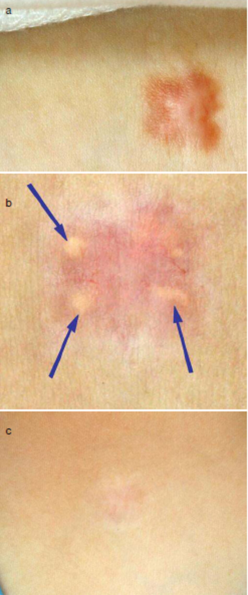 Fig. 2.28 Điều trị sẹo lồi với trong tổn thương corticosteroids, (a) Sẹo lồi. (b) u vàng, (c) Hồi quy tự phát (bằng mũi tên) của u vàng sau 8 tháng 