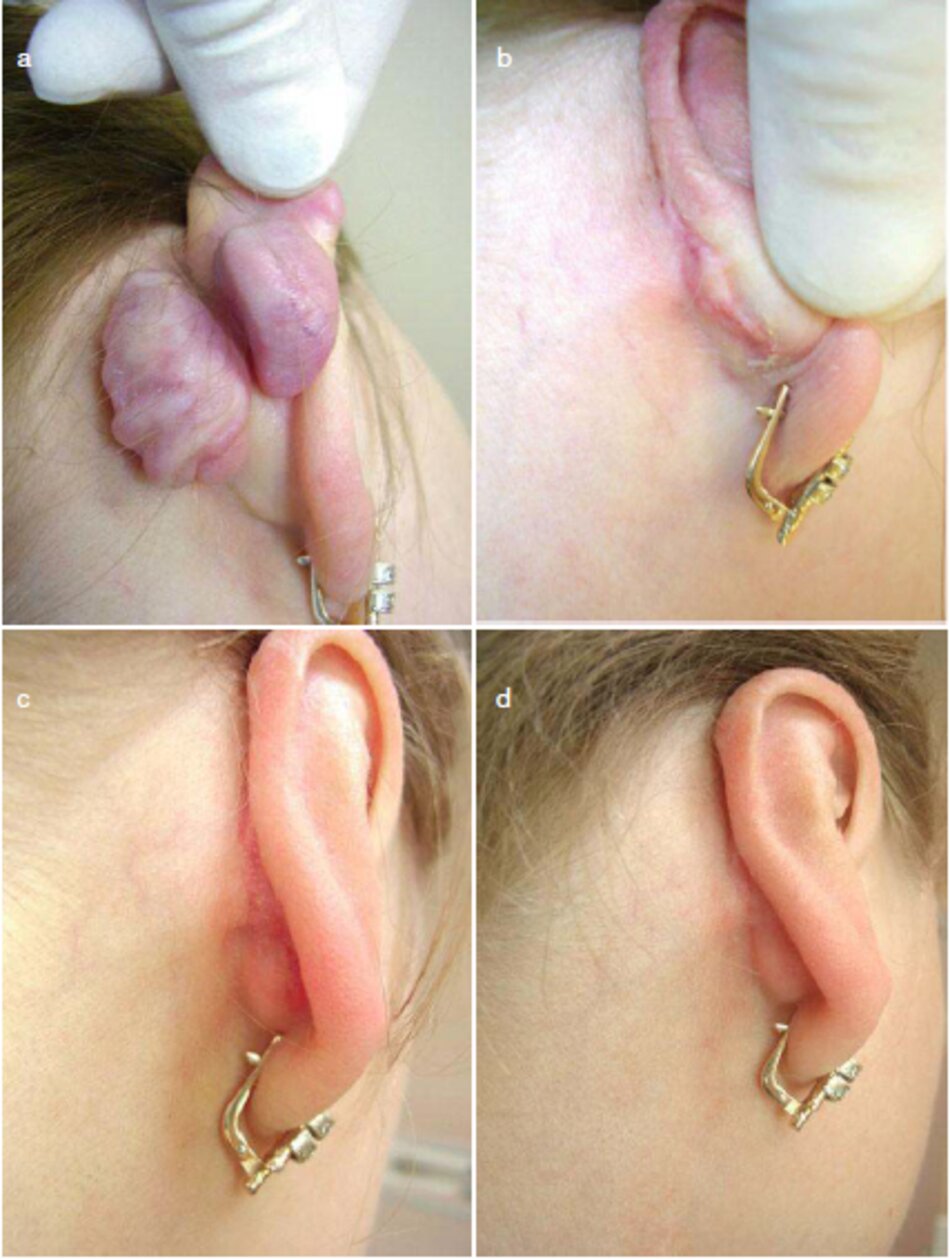 Fig. 2.32 Phẫu thuật cắt bỏ sẹo lồi tai và phòng ngừa tái phát sau phẫu thuật, (a) Trước khi điều trị. (b) Bổn tháng sau khi hoạt động, (c) Mười tháng sau khi hoạt động, (d) 1,5 năm sau khi hoạt động mà không có bất kỳ dấu hiệu tái phát nào