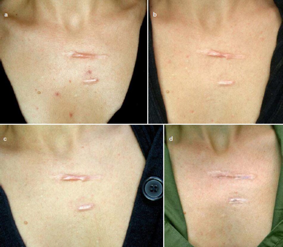 Fig. 2.40 Sẹo lồi hoạt động trên vùng ngực, (ra) Trước khi điều trị. (b) Một tháng sau thủ tục điều trị tăng sinh collagen (CIT) đầu tiên, (c) Một tháng sau thủ tục điều trị tăng sinh collagen (CIT) thứ hai. (d) Một tháng sau khi tiêm corticosteroid nội tại