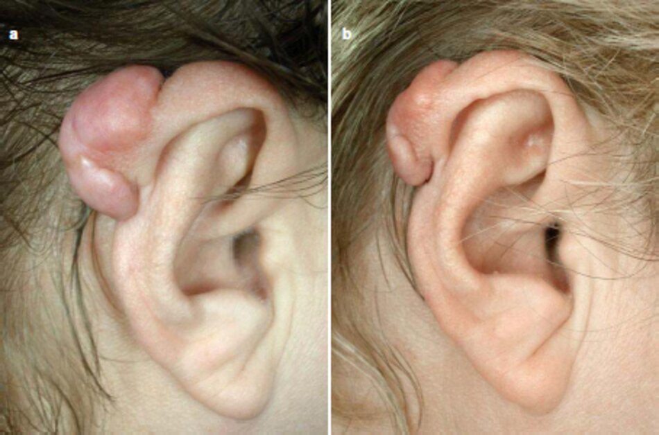 Fig. 2.45 Tái phát của sẹo lồi vành tai sau khi cắt bỏ phẫu thuật, (a) Trước khi điều trị. (b) Trong quá trình xử lý. Một tháng sau. (c) Sau khi điều trị. sáu tháng sau khi bắt đầu điều trị 