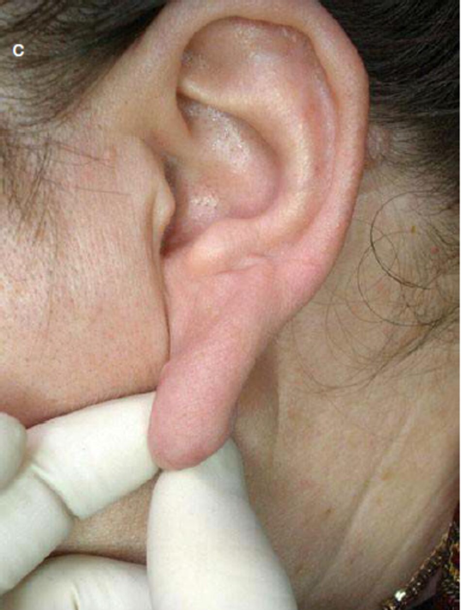 Fig. 2.46 Hai lần phẫu thuật cắt bỏ sẹo lồi dái tai trái, (a) Trước khi điều trị. (b) Trong quá trình điều trị. Sáu tháng sau. (c) Sau khi điều trị 