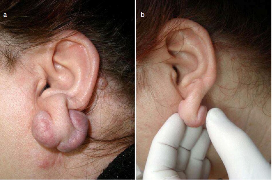 Fig. 2.46 Hai lần phẫu thuật cắt bỏ sẹo lồi dái tai trái, (a) Trước khi điều trị. (b) Trong quá trình điều trị. Sáu tháng sau. (c) Sau khi điều trị 