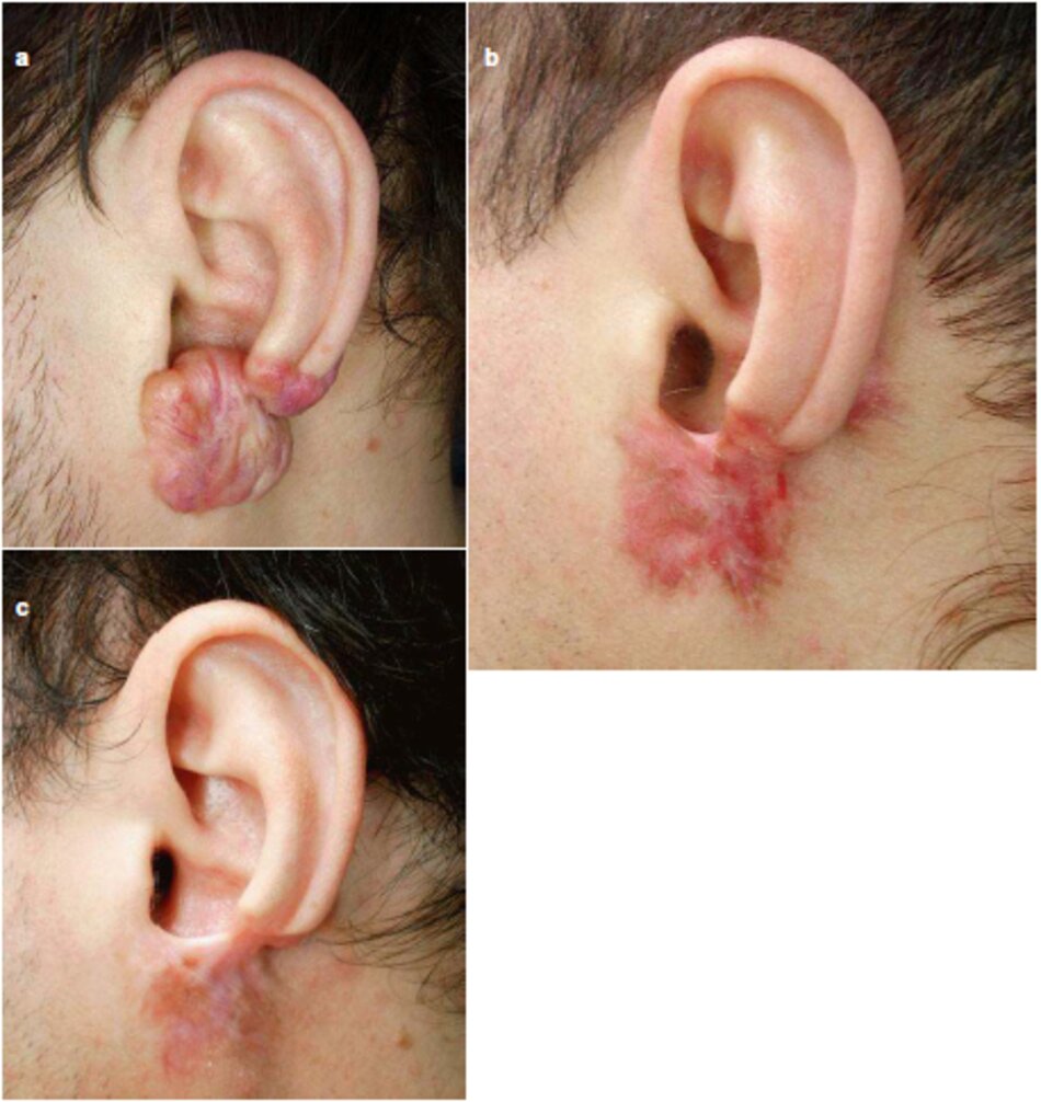Fig. 2.47 Tái sẹo lồi của dái tai trái, (a) Trước đây. (b) Sau 1,5 năm sau khi bắt đều điều trị. (c) Sau 3 năm