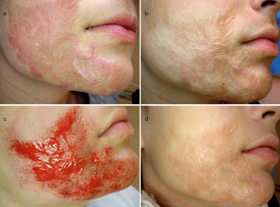 Fig. 2.61 vết sẹo bỏng trên má phải và vùng cằm. (a) Trước khi điều trị. (b) Sau khi điều tộ bằng laser, (c) Liệu pháp tăng sinh collagen {CIT, 1,5-mm Dermaroller), (d) sáu tháng sau CIT