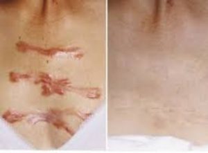Điều trị thẩm mỹ sẹo lồi trên ngực như thế nào trong bệnh lý về sẹo?