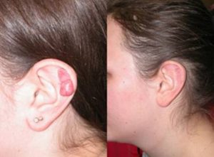 Sẹo lồi tai và phương pháp điều trị phù hợp nhất trong bệnh lý về sẹo